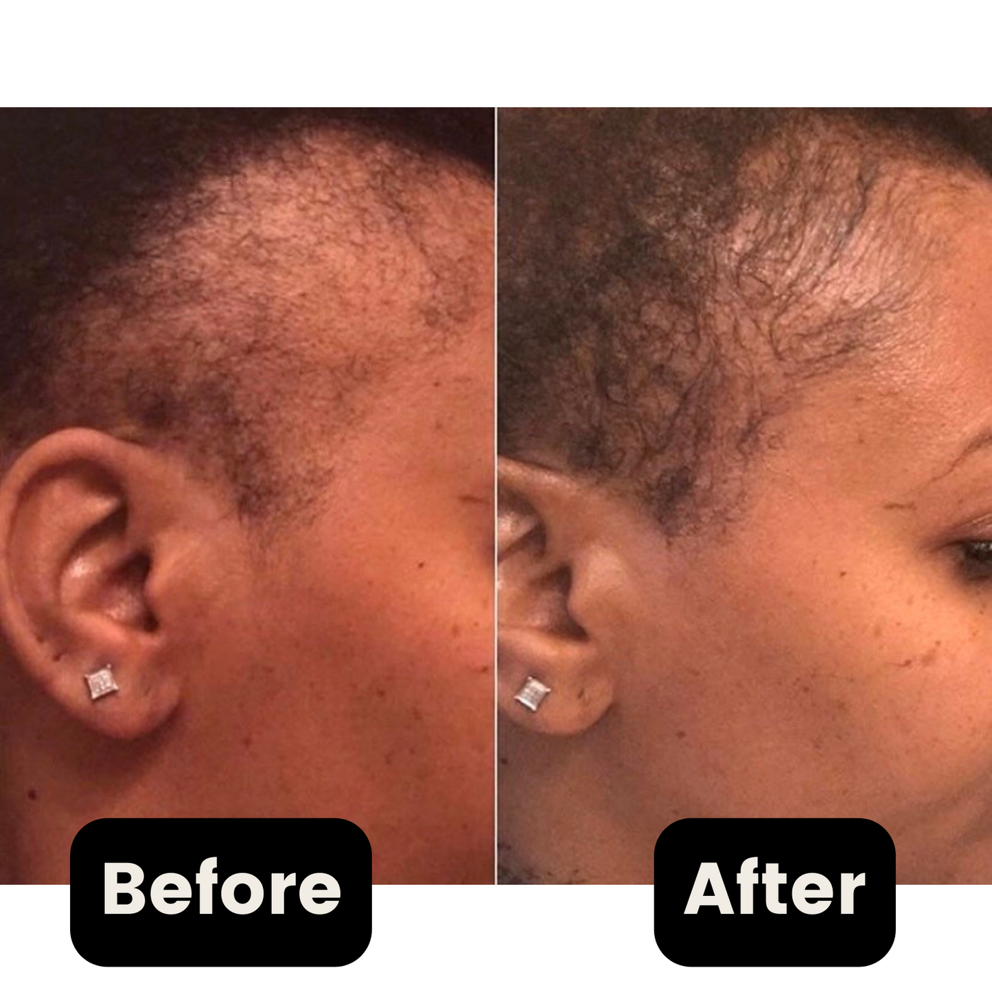 2 x Yes Melanin - Hair Growth Serum [60 Day Supply]